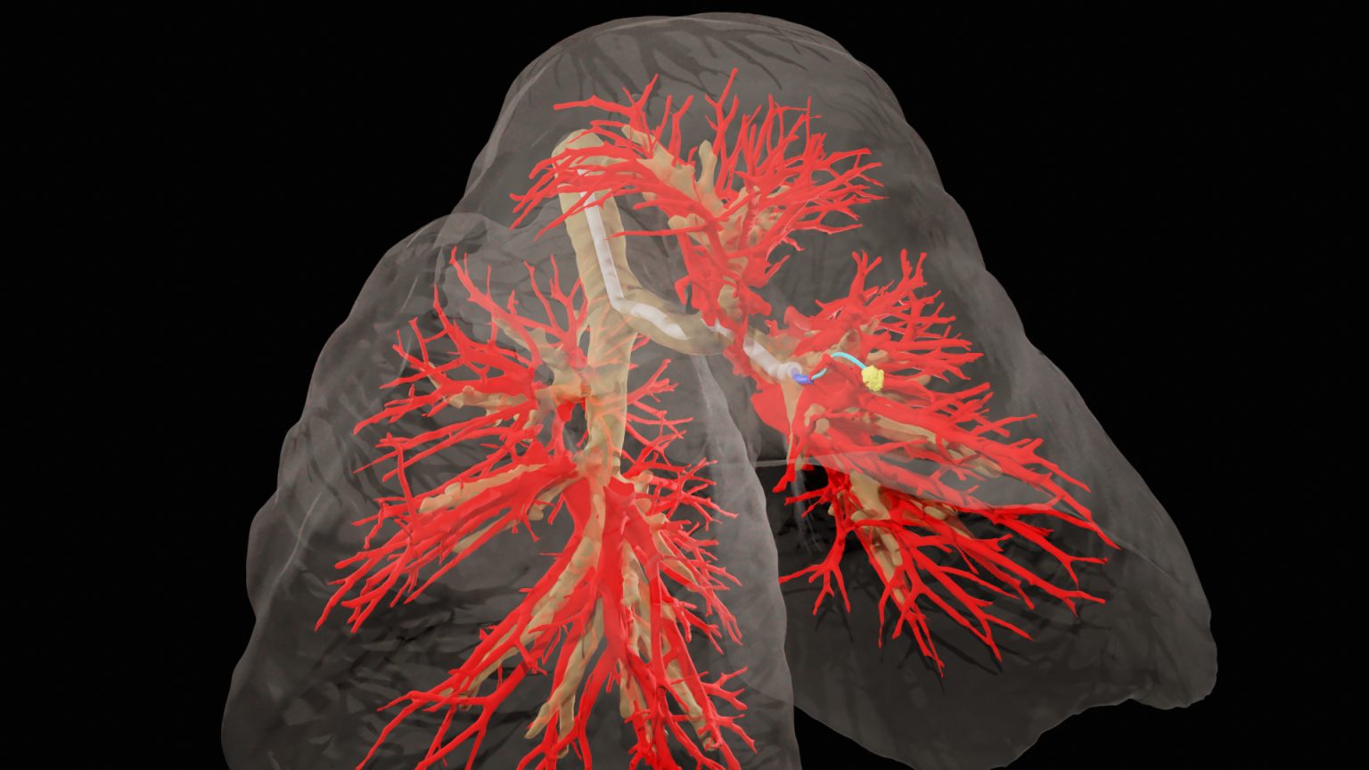 a digital rendering of a steerable needle device navigating human lungs